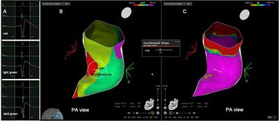 Prolonged Right Ventricular Outflow Tract Endocardial Activation Duration and Presence of Deceleration Zones in Patients With Idiopathic Premature Ventricular Contractions. Association With Low Voltage Areas